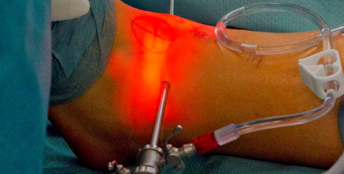Abbildung minimalinvasive Operation am Sprunggelenk