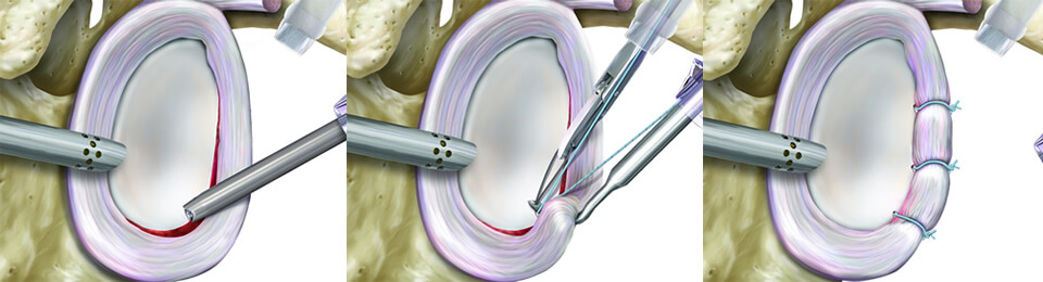 Schematische Abbildung einer Schulter Labrumrefixation