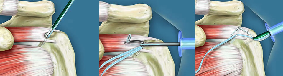 Schematische Abbildung von Schultersehnen